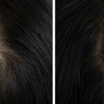 woman head hair baldness before and after treatment