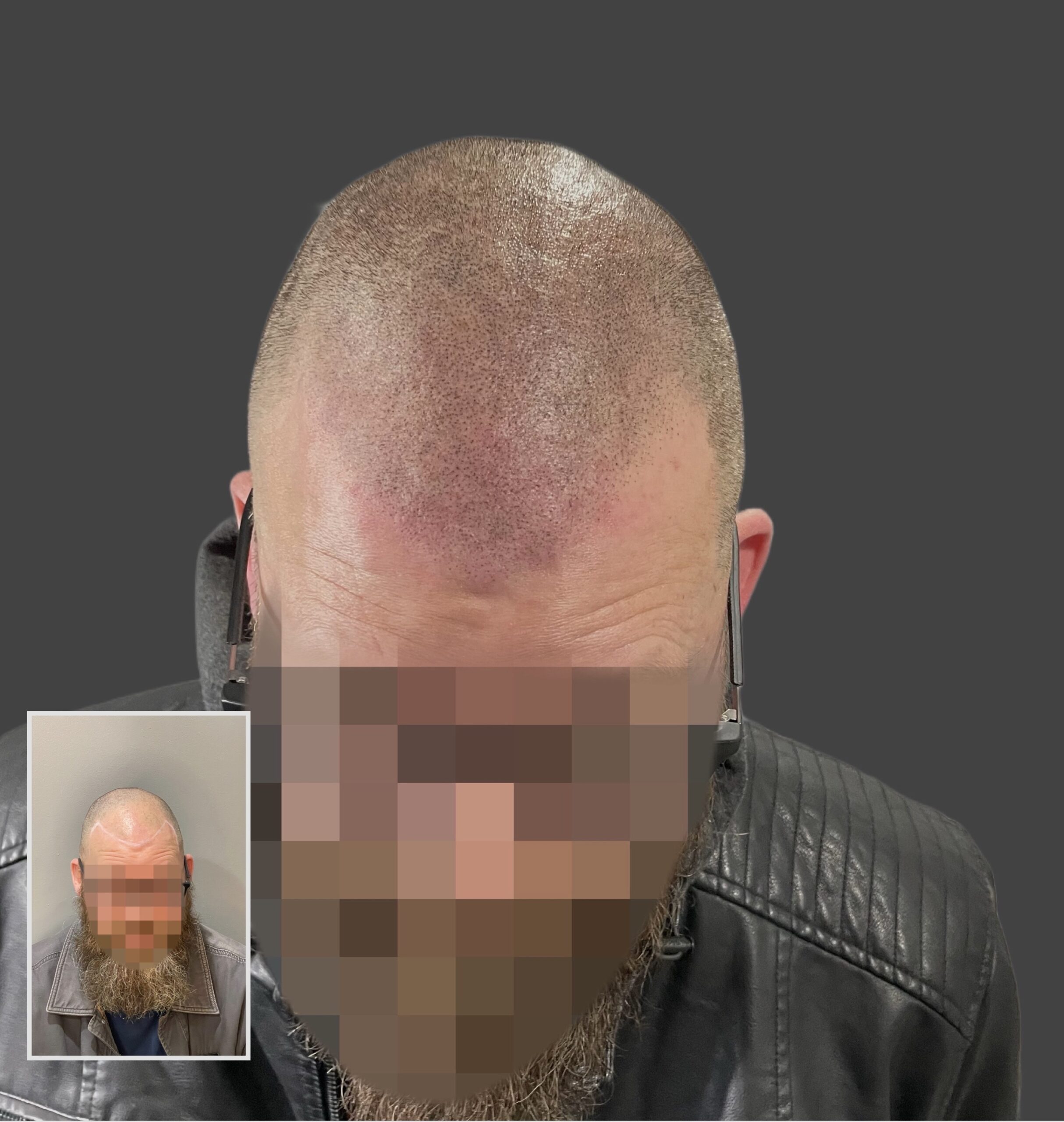 Scalp Micropigmentation Clinic In Cincinnati Scalp Micro Cincy