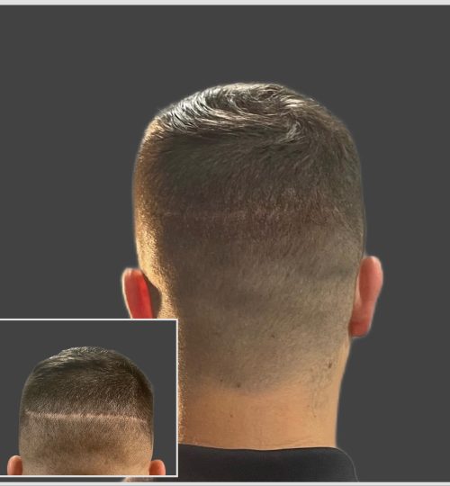 Scalp Micropigmentation Results Scalp Micro Cincinnati