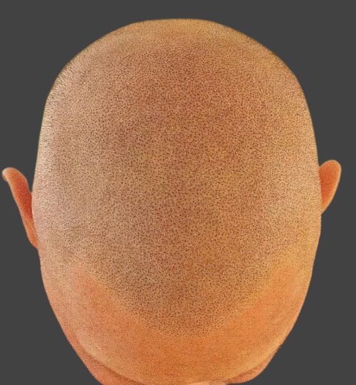 Scalp Micropigmentation Results Scalp Micro Cincinnati