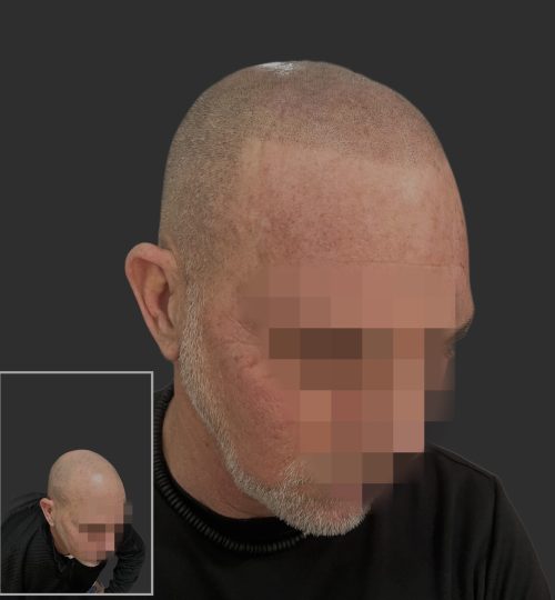 Scalp Micropigmentation Results Scalp Micro Cincinnati
